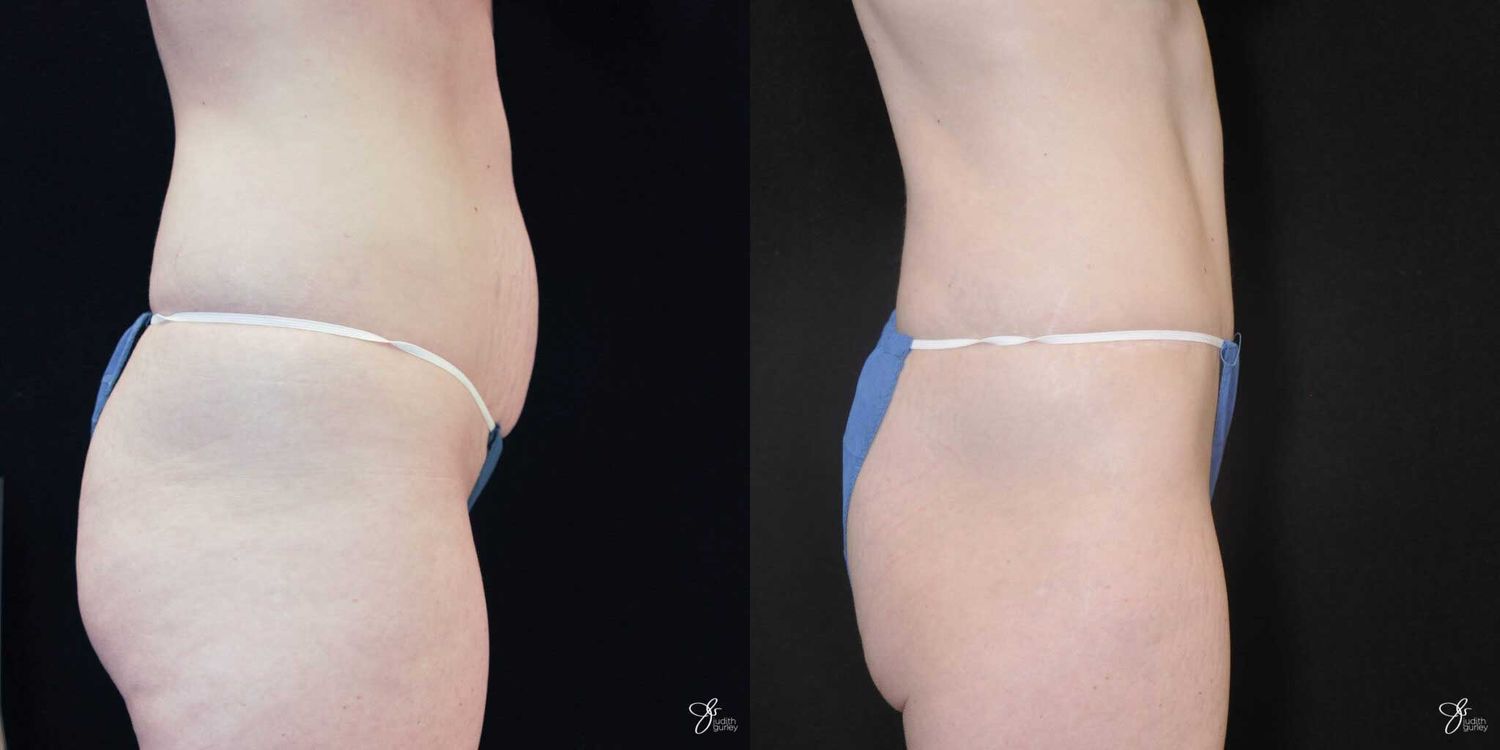 Tummy Tuck Before & After