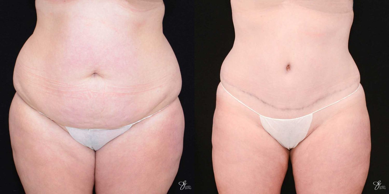 Tummy Tuck Before & After