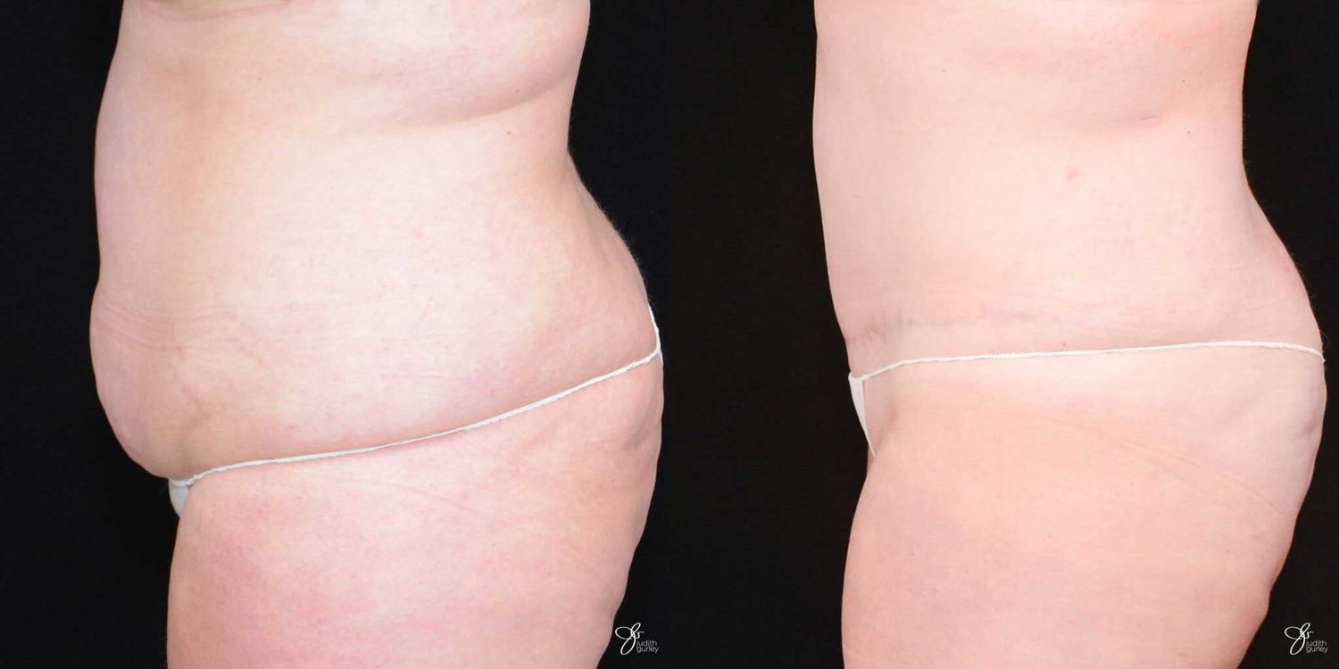 Tummy Tuck Before & After