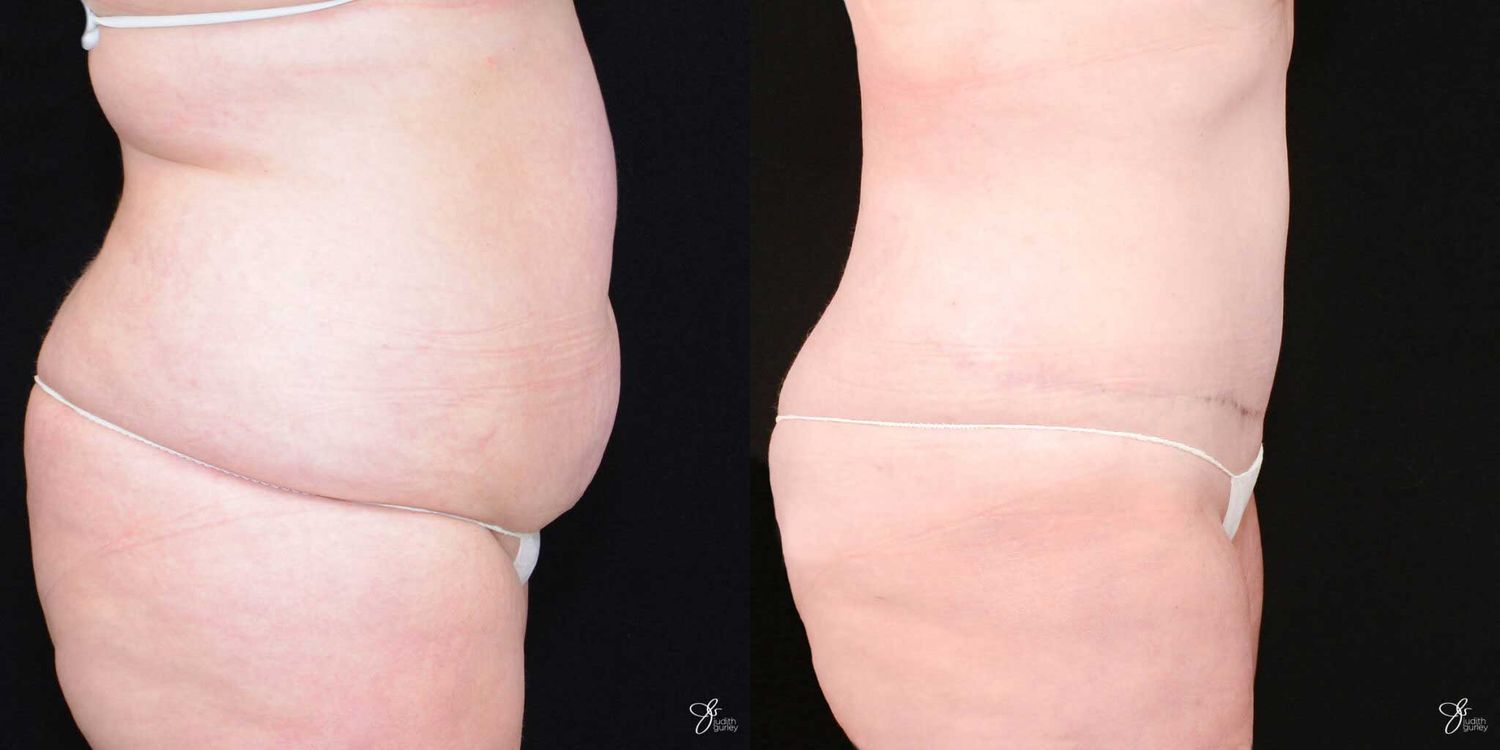 Tummy Tuck Before & After