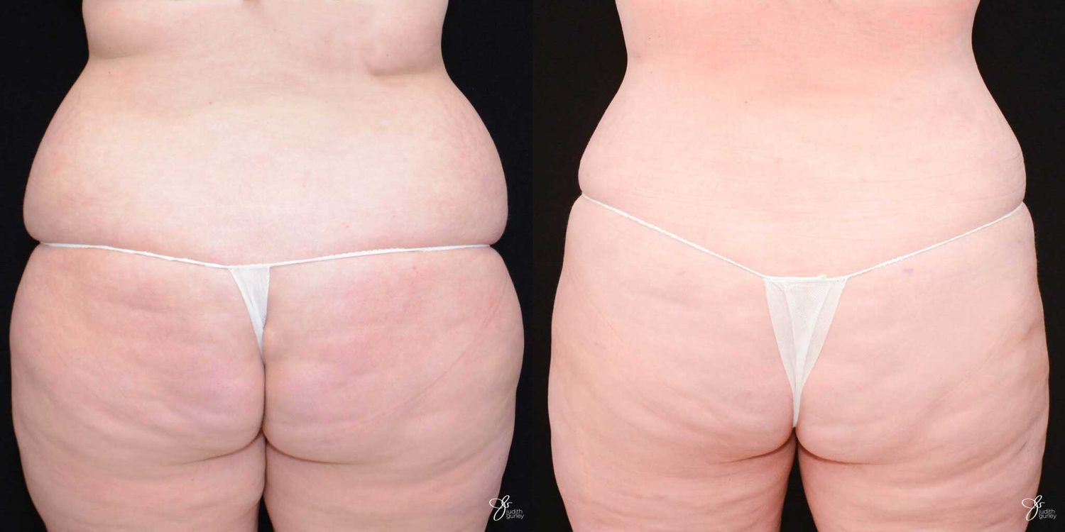 Tummy Tuck Before & After
