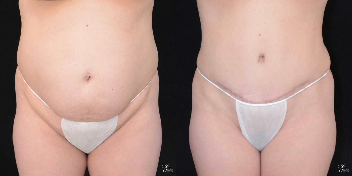 Tummy Tuck Before & After