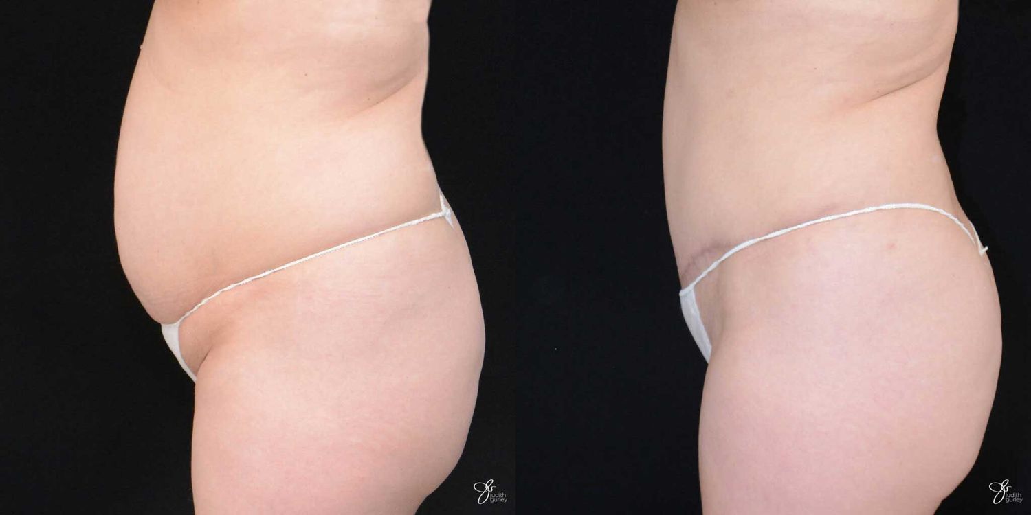 Tummy Tuck Before & After