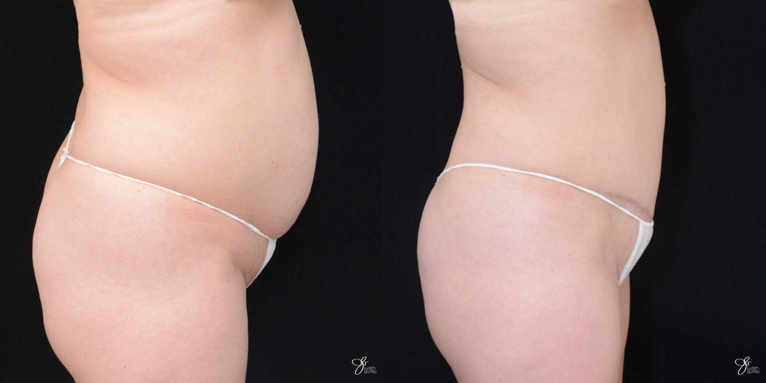Tummy Tuck Before & After