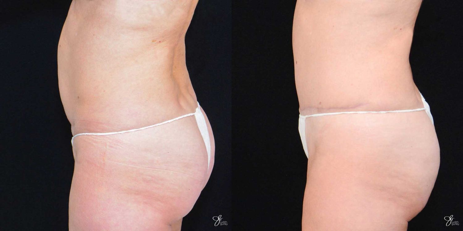 Tummy Tuck Before & After