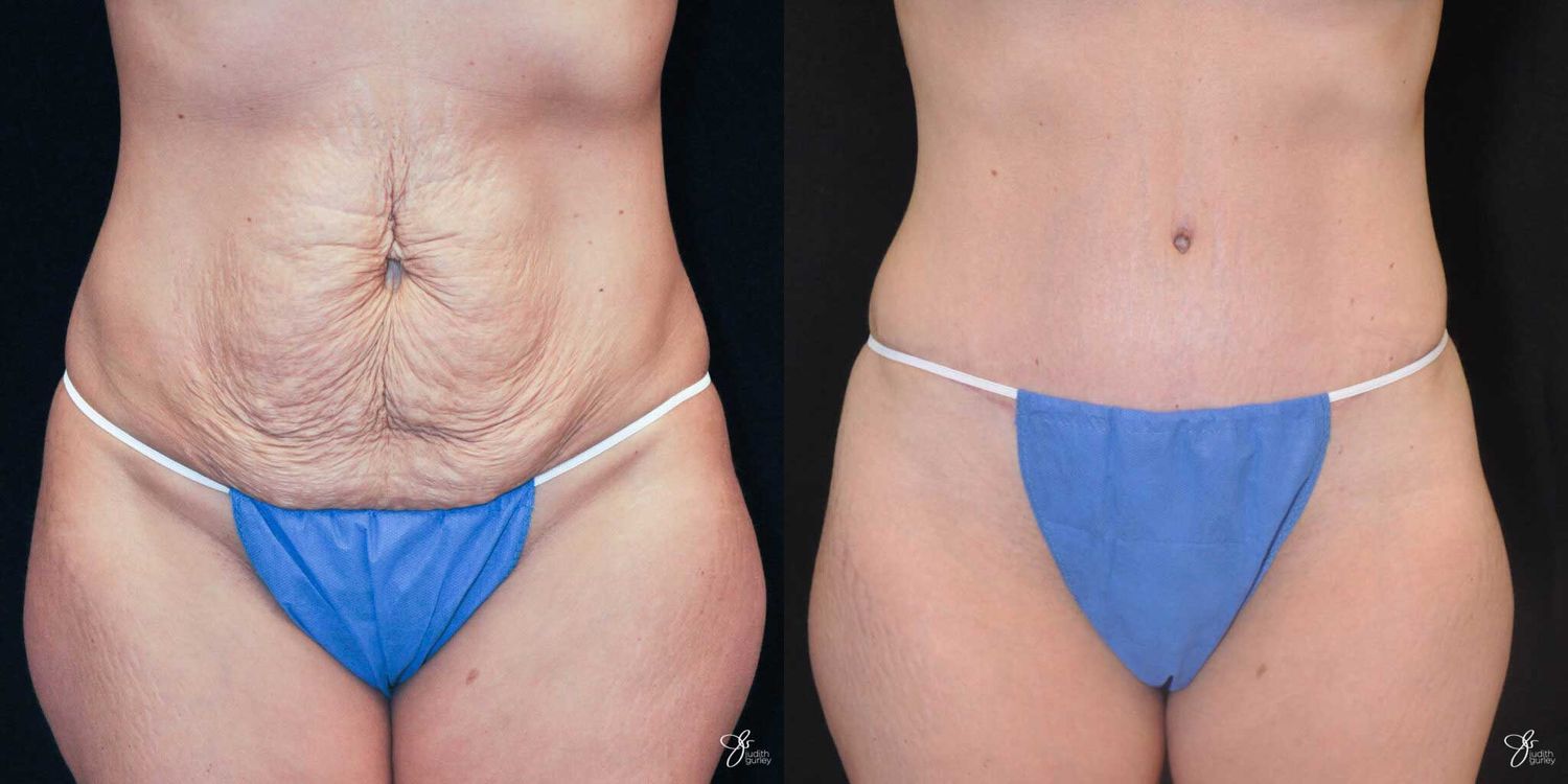 Tummy Tuck Before & After