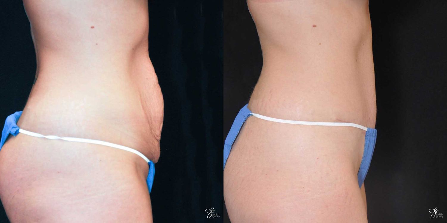 Tummy Tuck Before & After