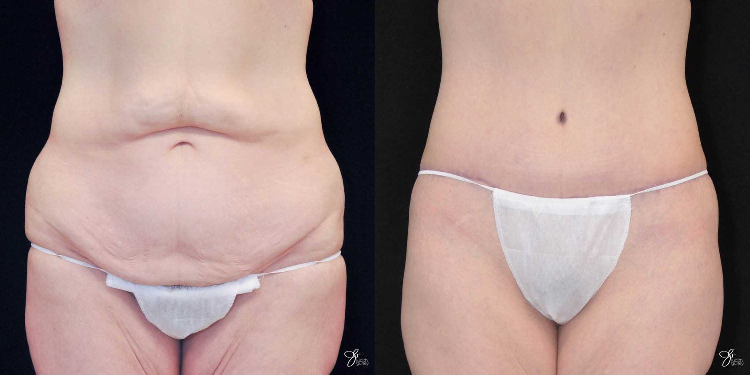 Tummy Tuck Before & After