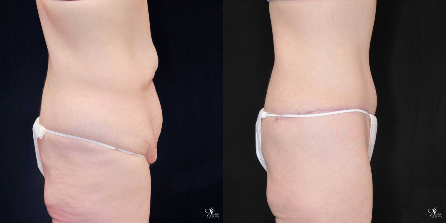 Tummy Tuck Before & After
