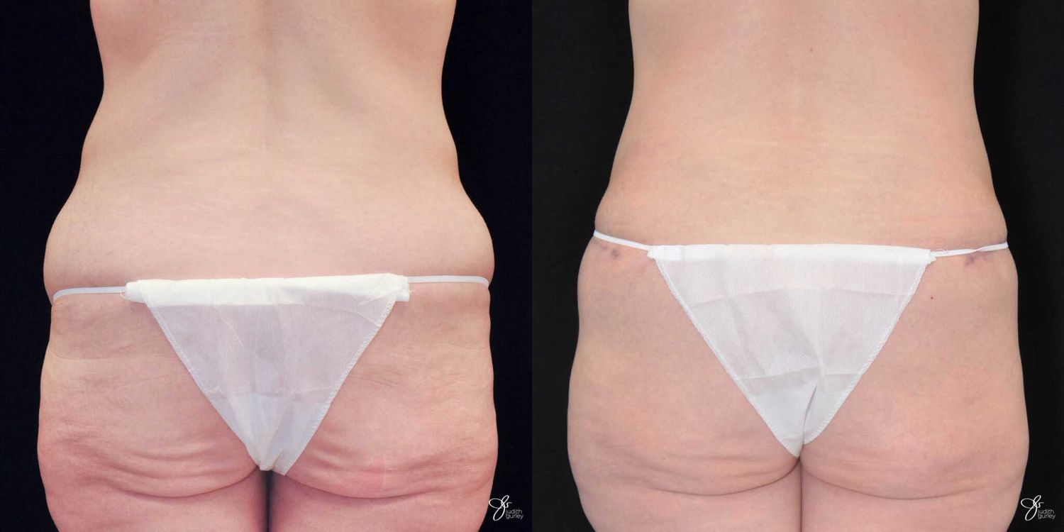 Tummy Tuck Before & After