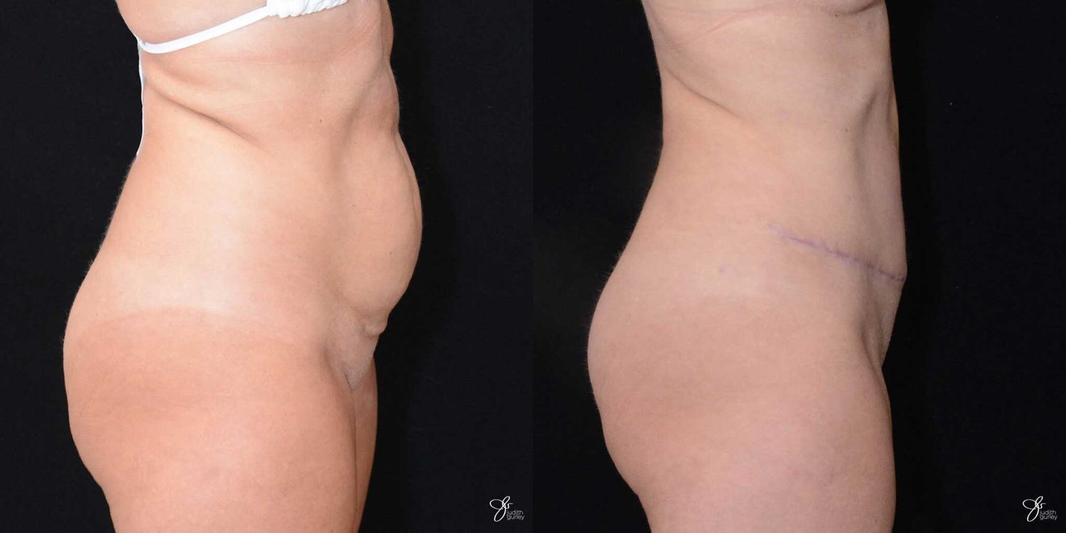 Tummy Tuck Before & After