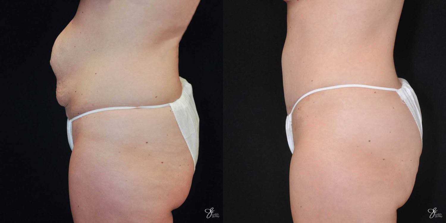 Tummy Tuck Before & After