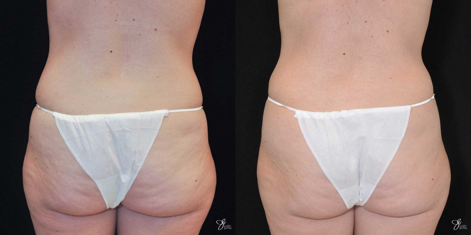 Tummy Tuck Before & After