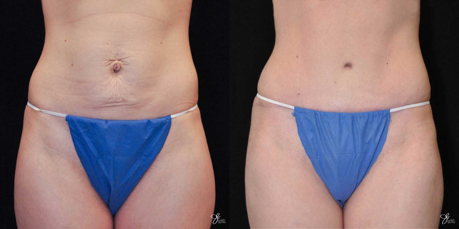 Tummy Tuck Before & After