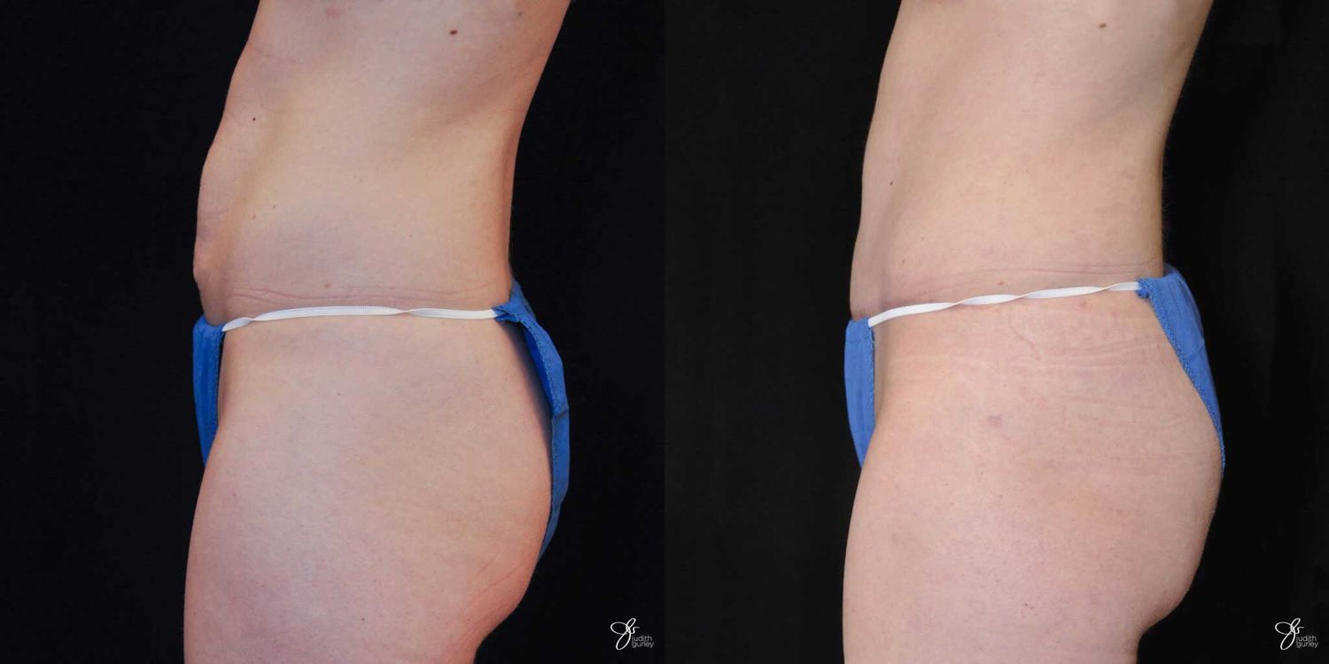 Tummy Tuck Before & After