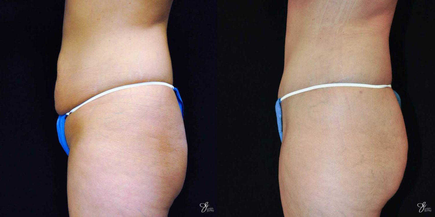 Tummy Tuck Before & After