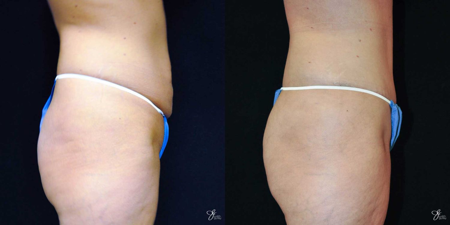 Tummy Tuck Before & After