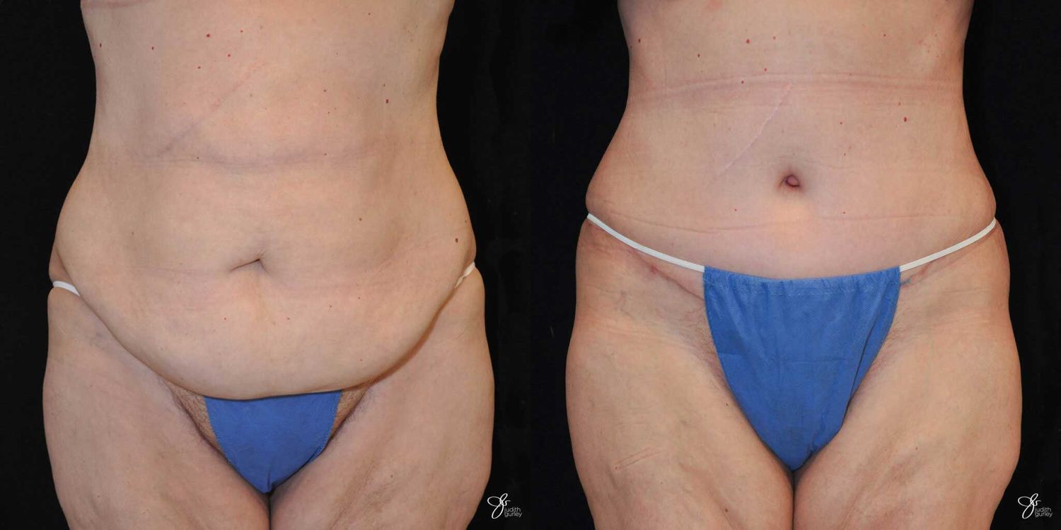 Tummy Tuck Before & After
