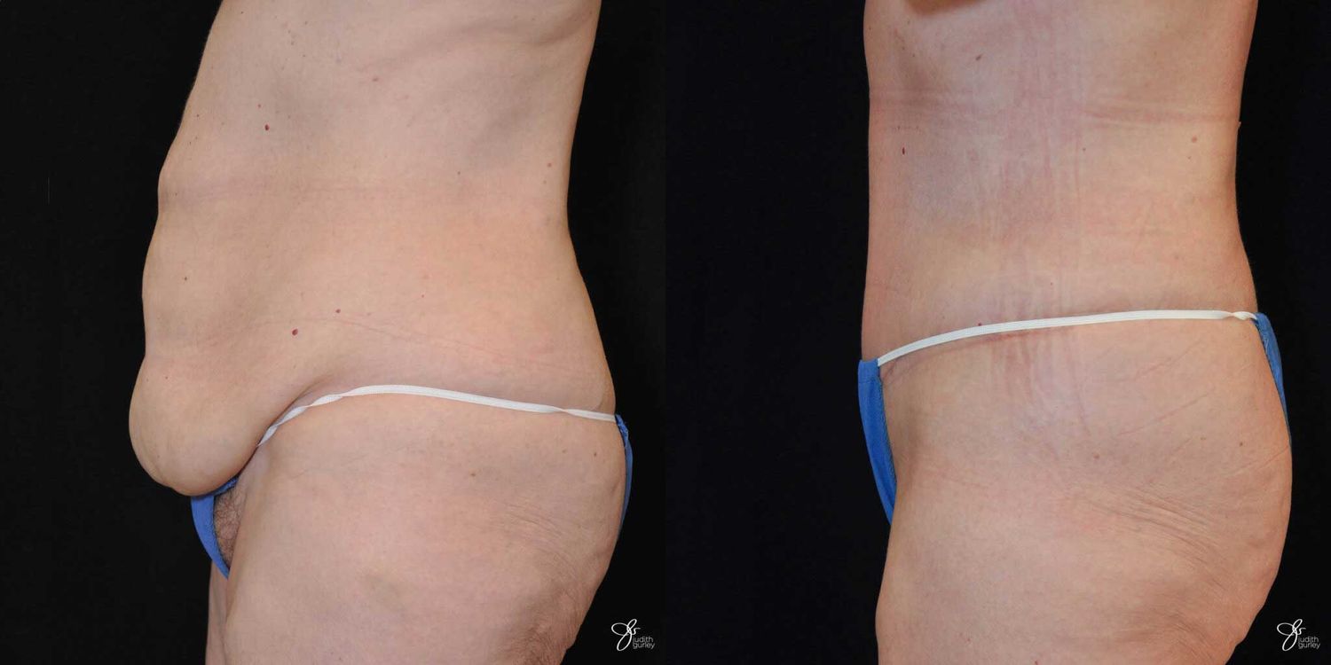 Tummy Tuck Before & After