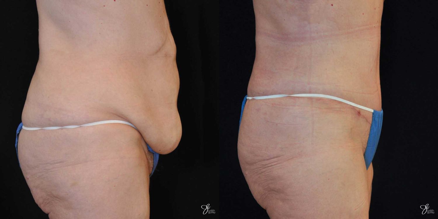 Tummy Tuck Before & After
