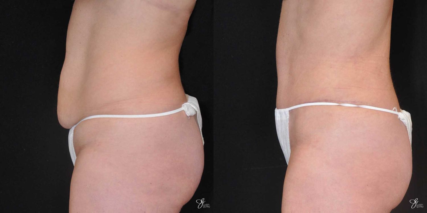 Tummy Tuck Before & After