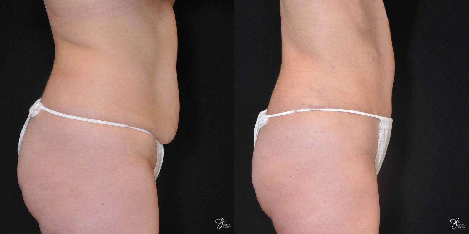 Tummy Tuck Before & After