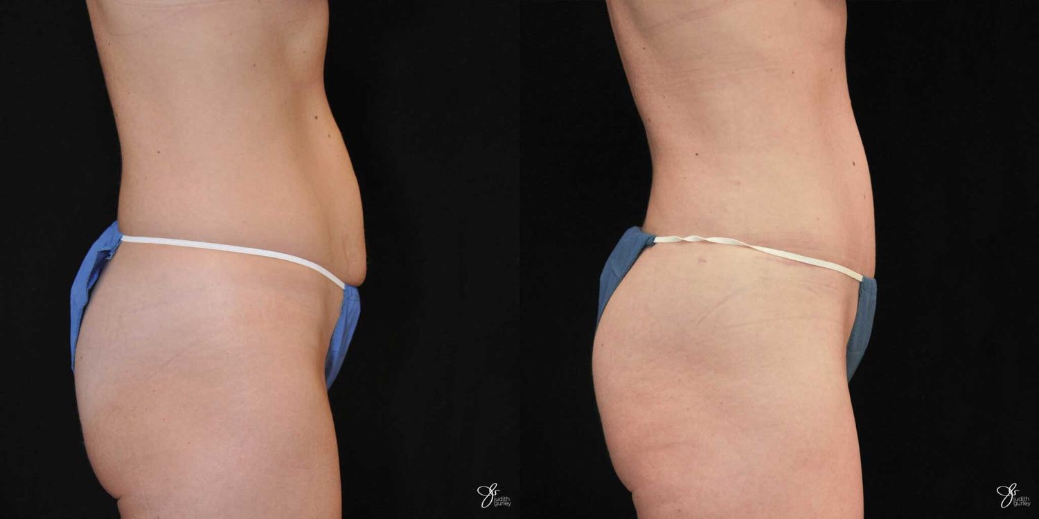 Tummy Tuck Before & After