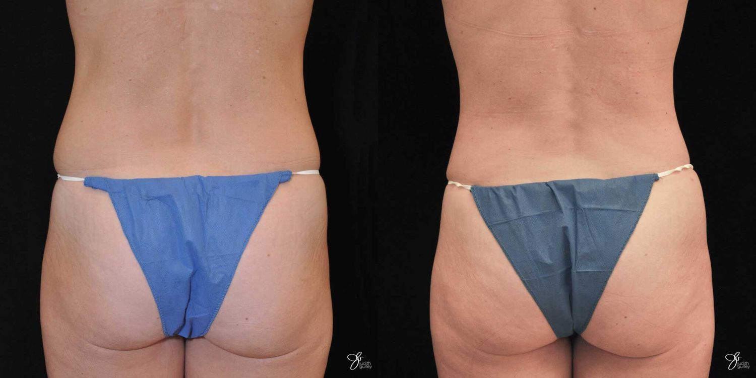 Tummy Tuck Before & After