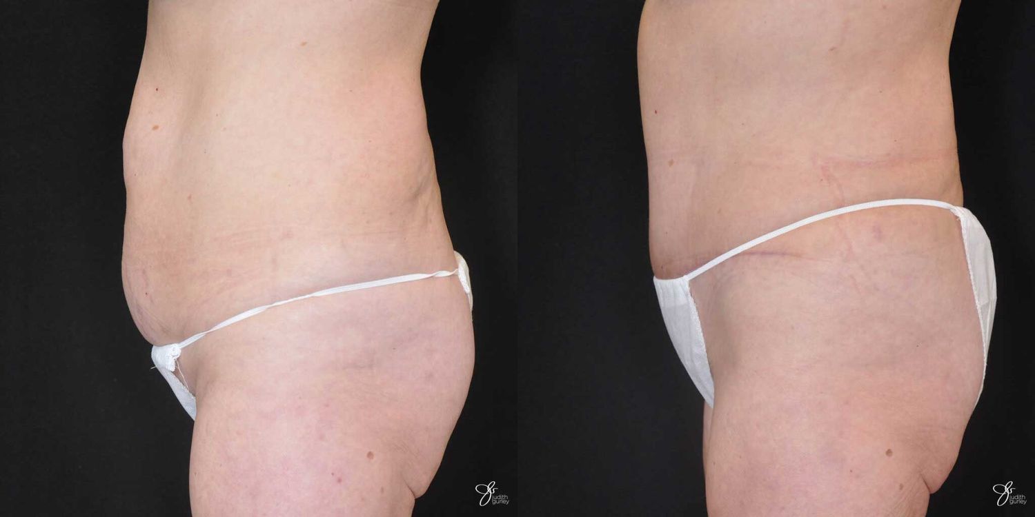 Tummy Tuck Before & After