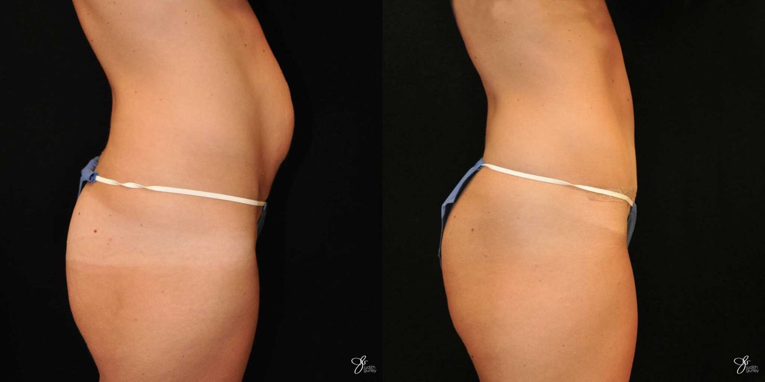 Tummy Tuck Before & After