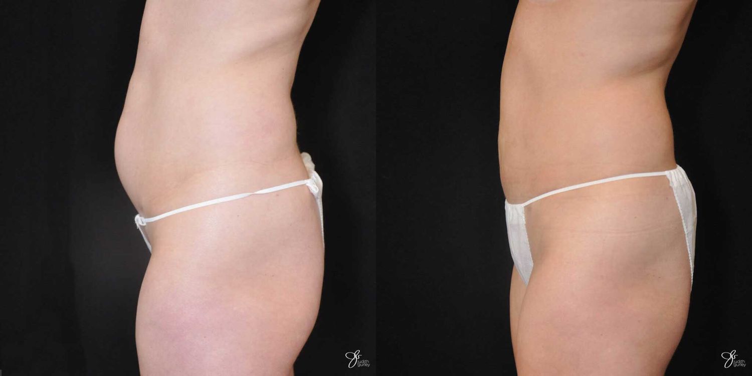 Tummy Tuck Before & After