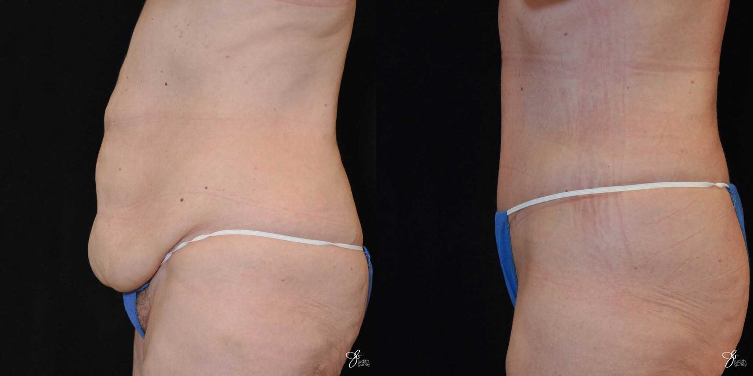 Tummy Tuck Before & After