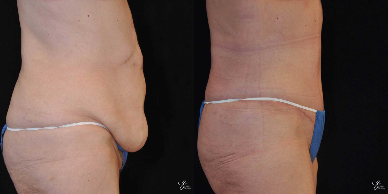 Tummy Tuck Before & After