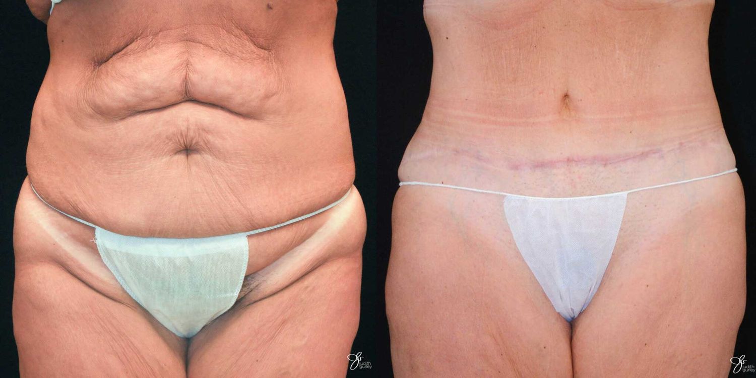 Tummy Tuck Before & After