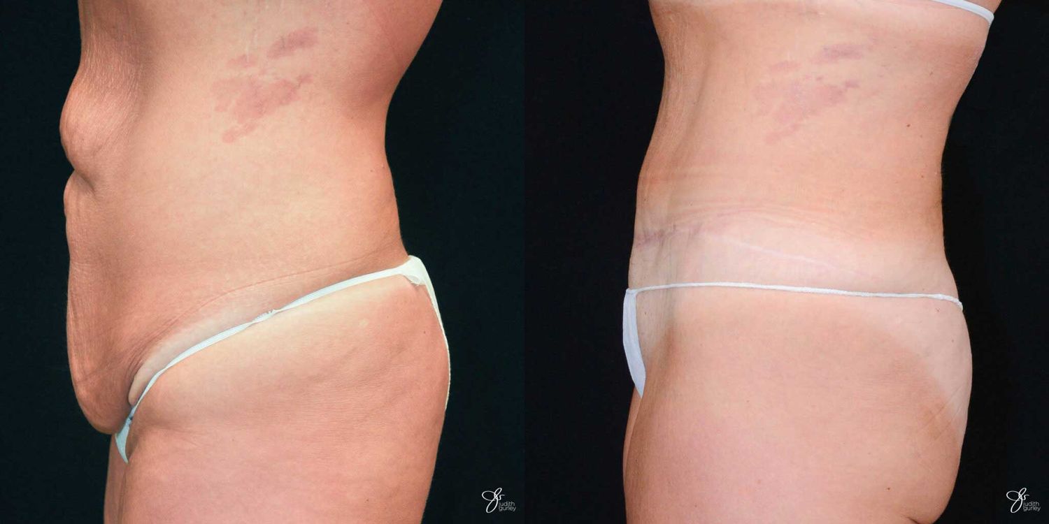 Tummy Tuck Before & After