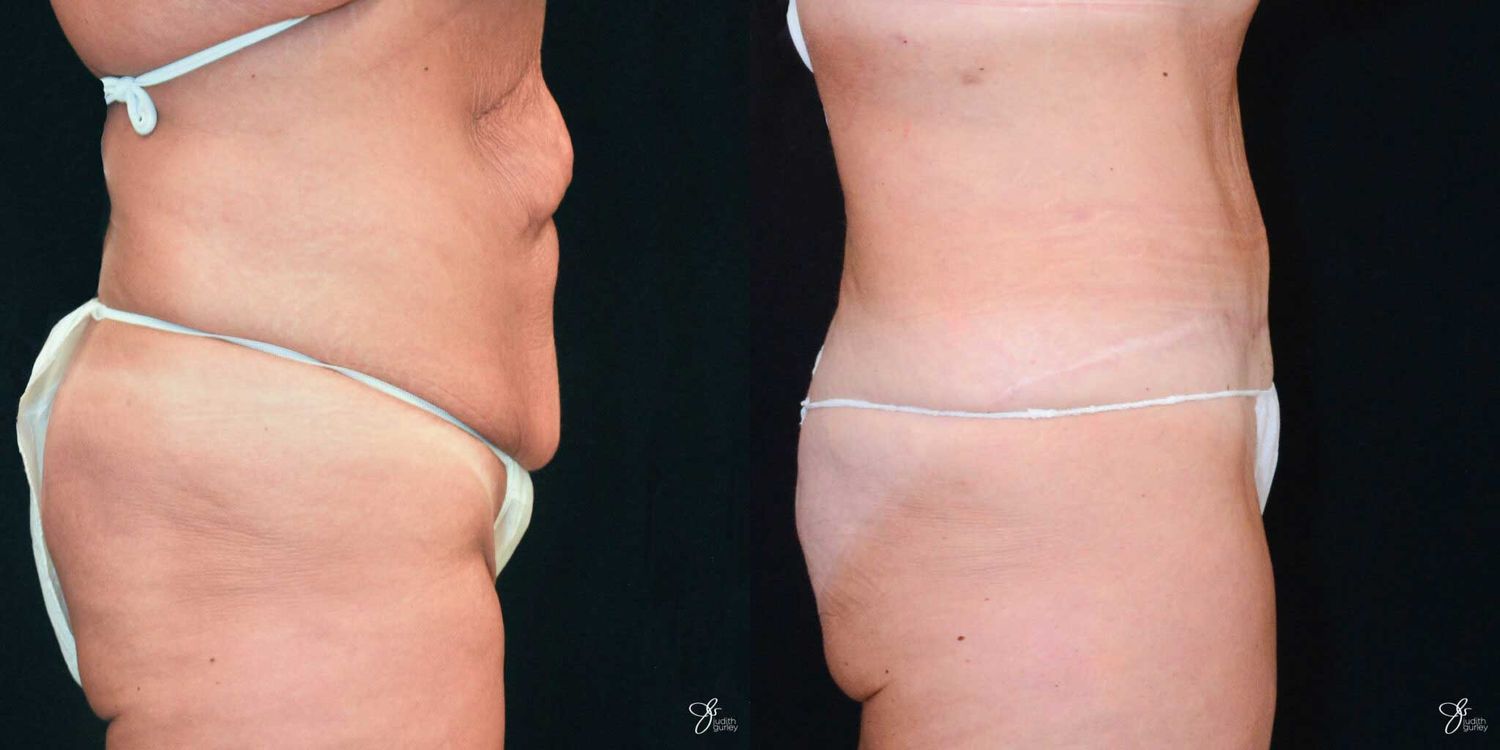 Tummy Tuck Before & After