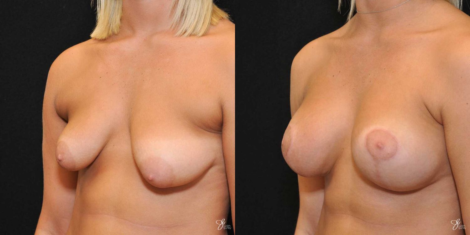 Tubular Breast Correction Before & After
