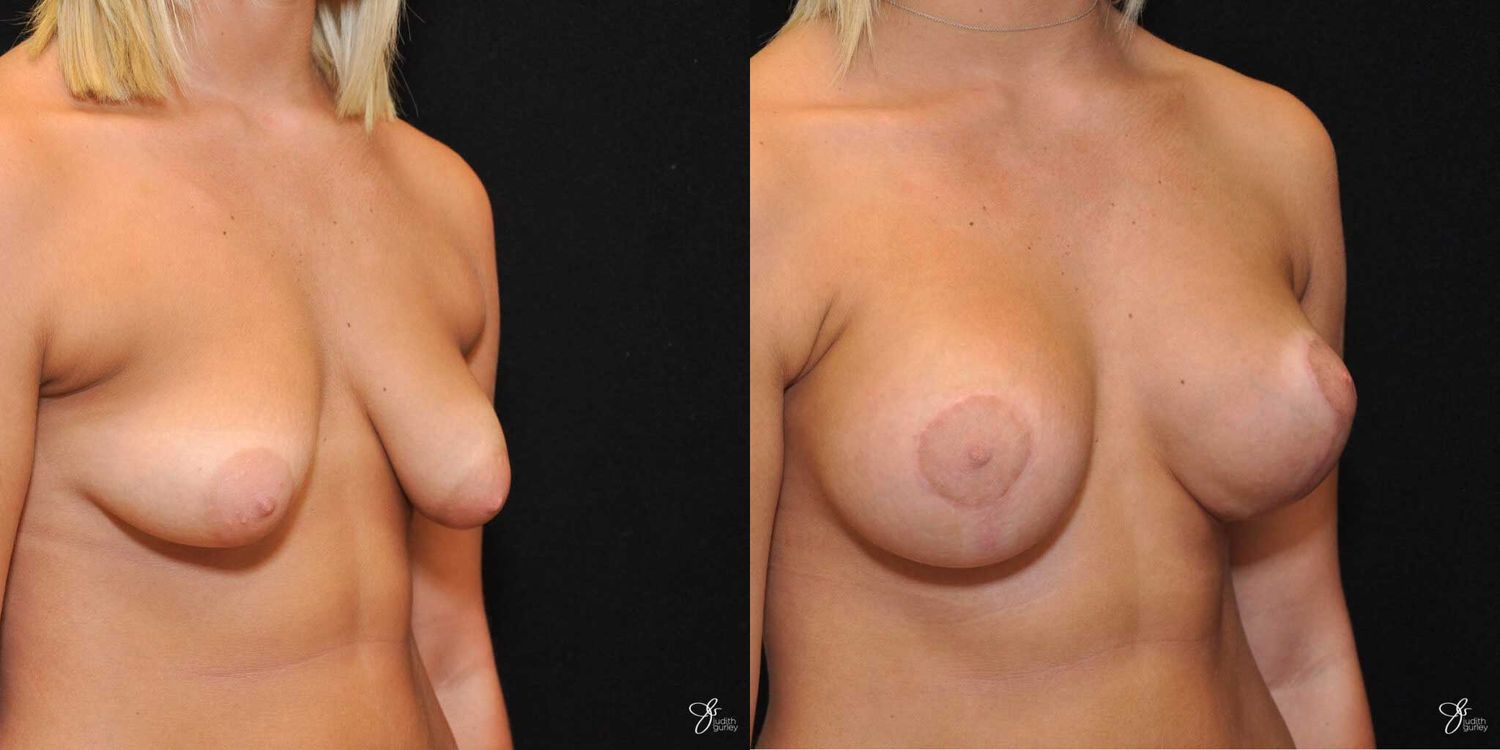 Tubular Breast Correction Before & After