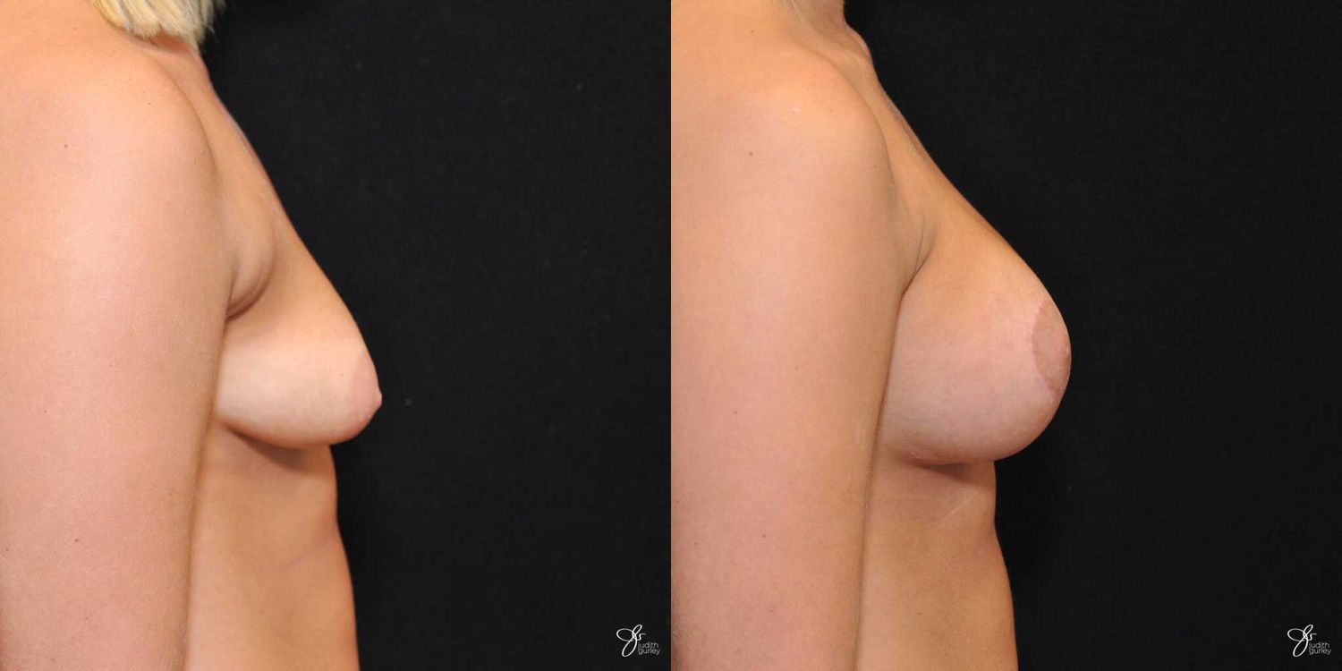 Tubular Breast Correction Before & After