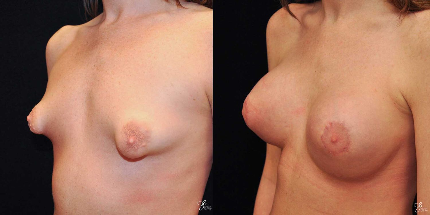 Tubular Breast Correction Before & After