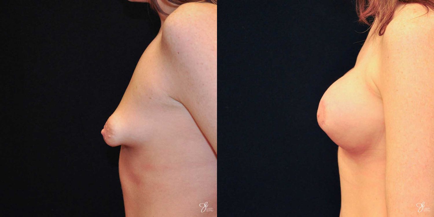 Tubular Breast Correction Before & After