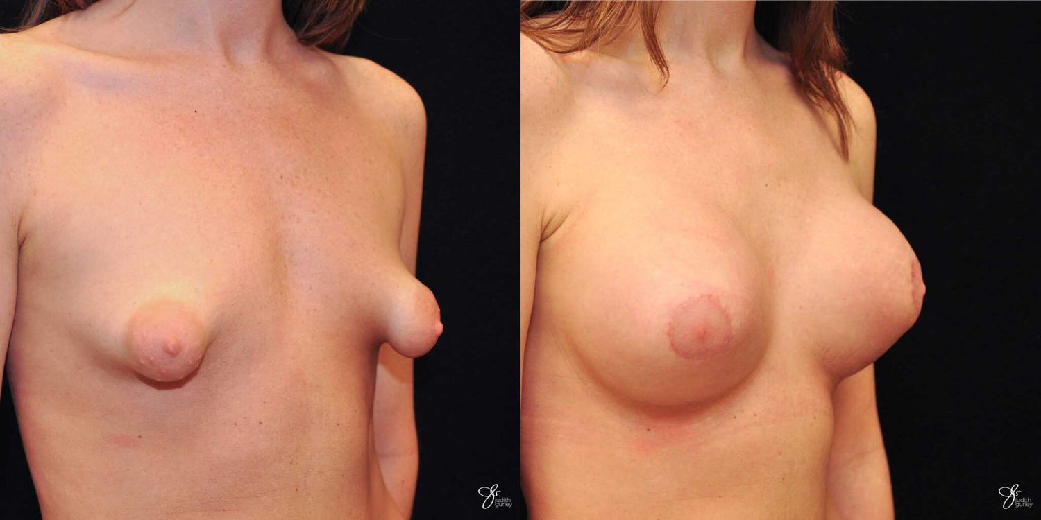 Tubular Breast Correction Before & After