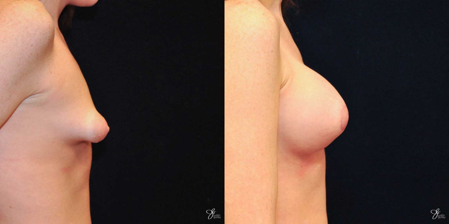 Tubular Breast Correction Before & After