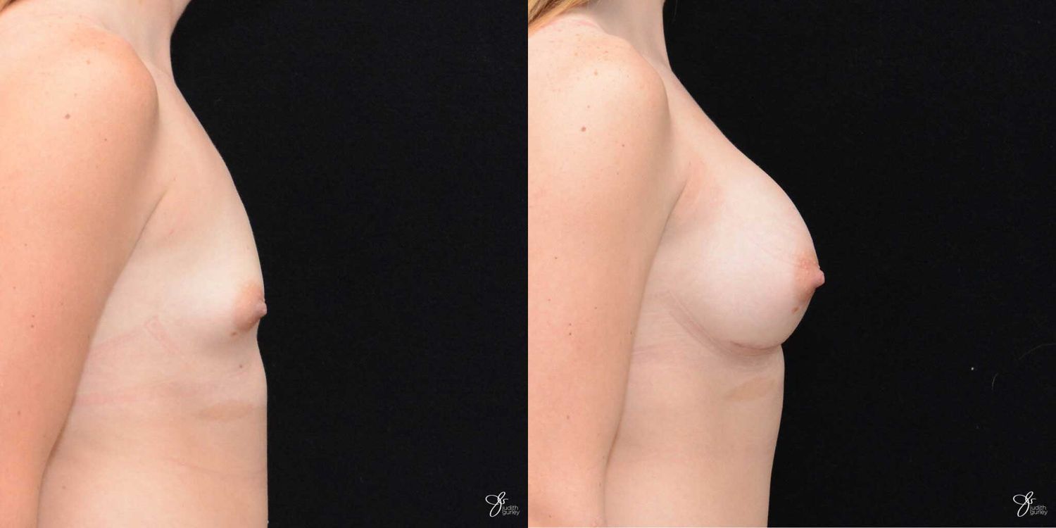 Tubular Breast Correction Before & After