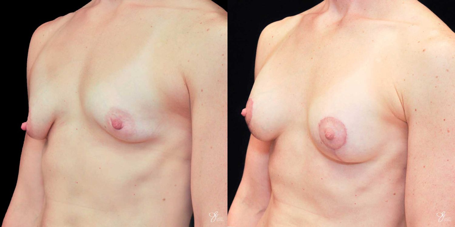 Tubular Breast Correction Before & After