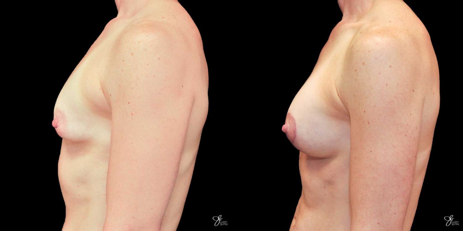 Tubular Breast Correction Before & After