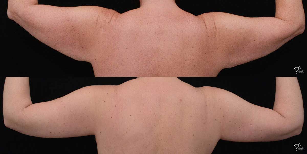 Arm Lift Before & After