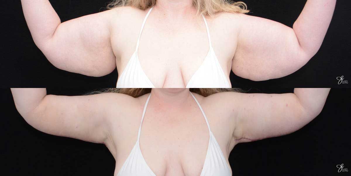 Arm Lift Before & After