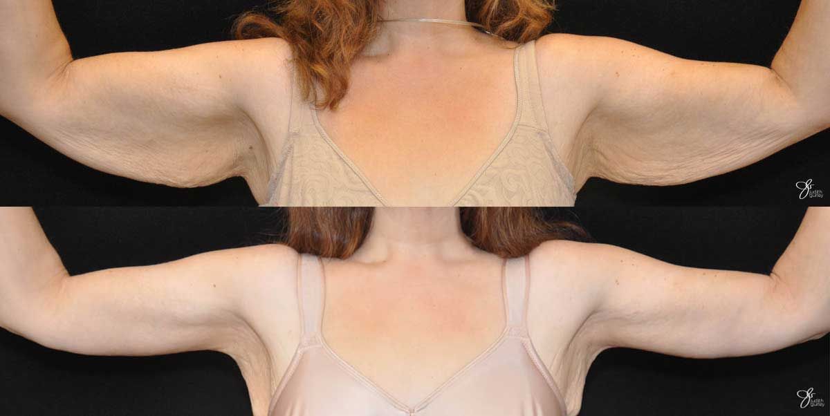 Arm Lift Before & After