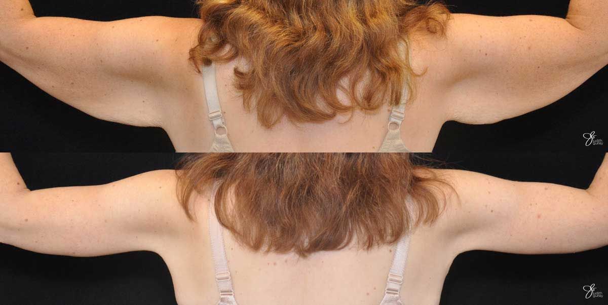 Arm Lift Before & After